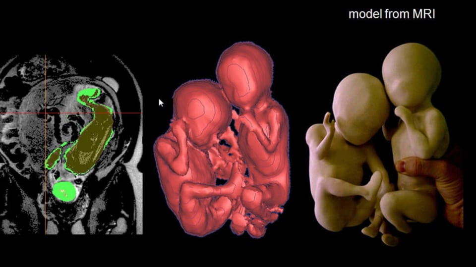 3D sken embrya